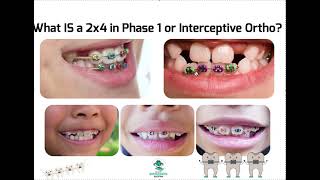 What is a 2x4 in Interceptive Ortho? Phase 1 Braces Explained