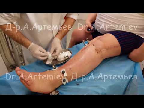 Снятие аппарата Илизарова после коррекции голени
