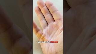 Causes of Dupuytren’s Disease Explained (Viking Hand)