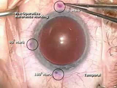 INSTRUMENT SET FOR IMPLANTATION OF THE TORIC LENS