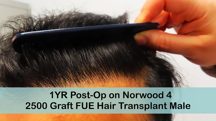 Male 1-Year Post-Op Norwood 4 FUE