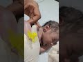 IV Vigo fixing in hospital |New born baby IV canulation on hospital |#shorts #vigo #vigovideo #baby