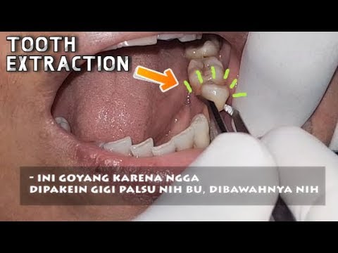 Tooth Extraction | Pencabutan Gigi | Gigi Goyang | Dokter Gigi