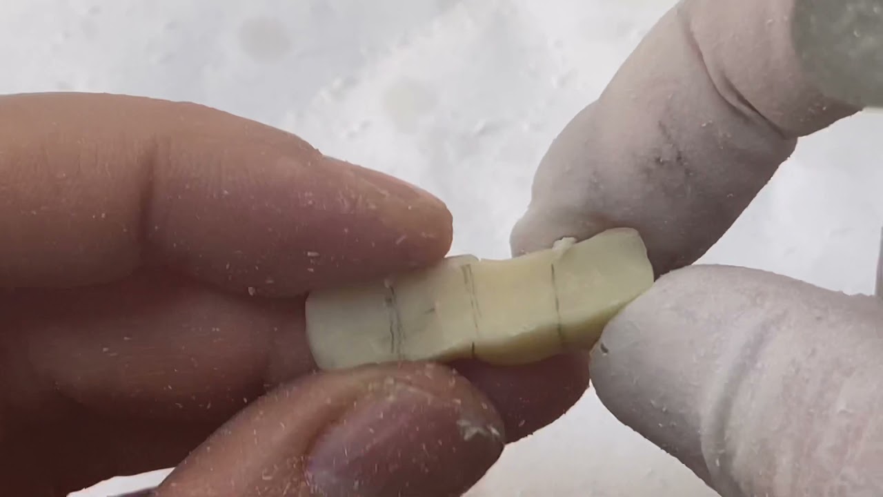 하악 4구치 커스텀어버트먼트에 임시치아 제작 (provisional restoration)