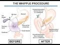 minimal invasive whipple's operation