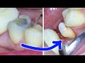 Full dental crown procedure after a root canal on a molar permanent  temporary tooth cap guide