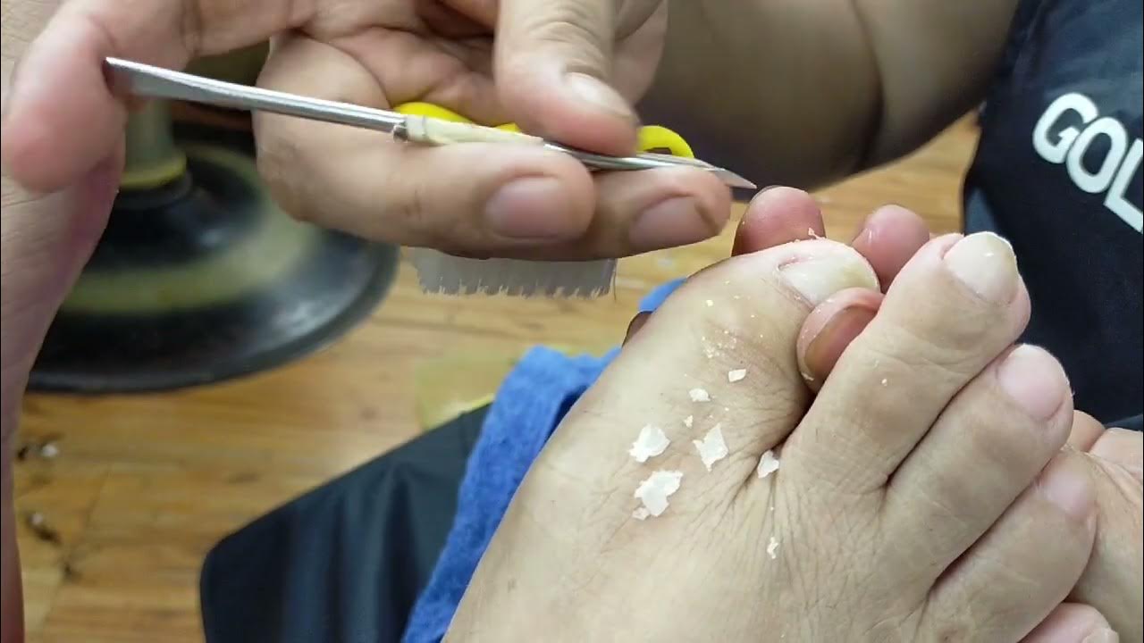 Vlog 06 How to remove dry skin+ingrown/step by step Pedicure 05 YouTube