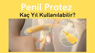 Penil Protez Mutluluk Çubuğu Kaç Yıl Kullanılabilir? -Prof Dr Ömer Faruk Karataş