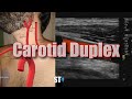 Carotid Duplex Exam