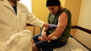 Complete Bicep Tendon Rupture | 10 Days after Surgery