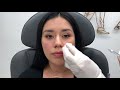 Instructional video how to do under eye fillers with a cannula, cheek and chin fillers natural