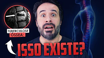 Como se contrai tuberculose nos ossos?