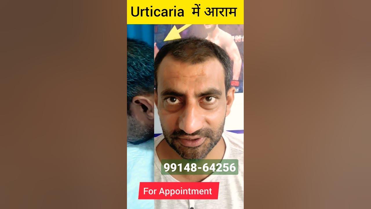 urticaria-shortfeed-shortvideo-shortsfeed