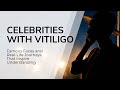 Vitiligo Revealed Through Stories of Michael Jackson, Winnie Harlow, Martha Stewart, Edward Philippe