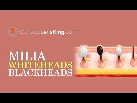 Video: Blackheads Vs. Whiteheads: Vad är Skillnaden?