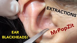 Very close up ear blackhead extractions. Front row seat to loop extractor technique for ear pops!