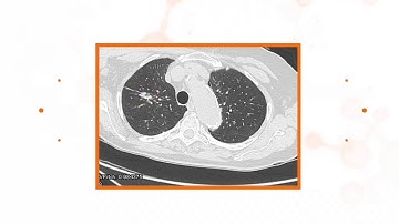 Case studies using Nodify Lung™ testing