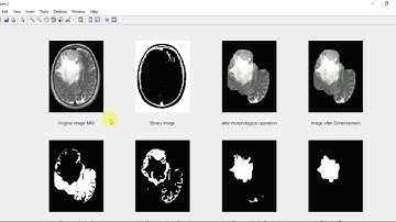 Segmentation of tumor | image processing | Computer vision | Matlab projects
