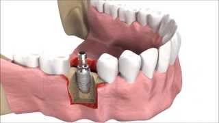 How DENTAL IMPLANTS are inserted | 3D simulation