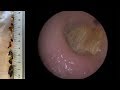 MOST CHALLENGING EAR WAX & DEAD SKIN REMOVAL !! - #429
