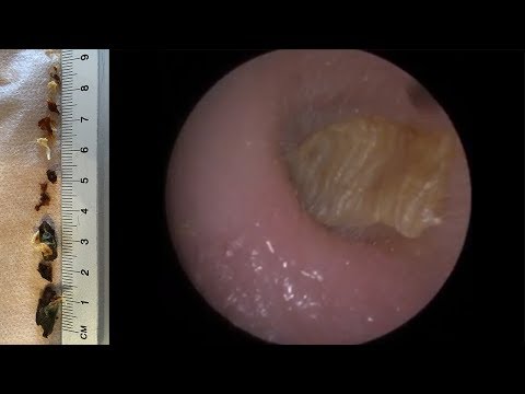 MOST CHALLENGING EAR WAX & DEAD SKIN REMOVAL !! - #429