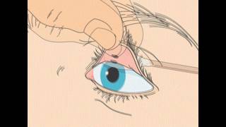 How to remove a foreign body from the eye