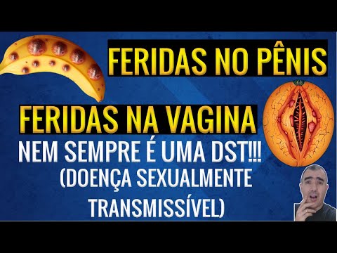 Vídeo: Feridas No Pênis: O Que Causa Feridas E Bolhas Na Ponta Ou No Eixo?