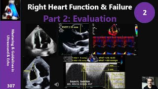 Right Heart Function & Failure Part 2: Evaluation