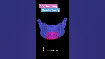 3D planning for mentoplasty surgical guides.