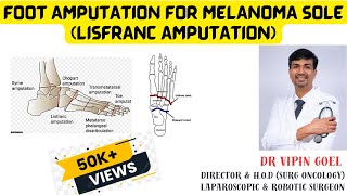 FOOT AMPUTATION for MALIGNANT MELANOMA SOLE (LISFRANC AMPUTATION) by Dr Vipin Goel