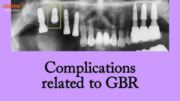 Surgery Series 3 (9) : Complications related to GBR