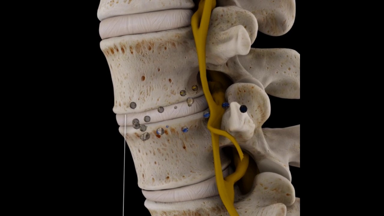 Degeneracion disco Lumbar - YouTube