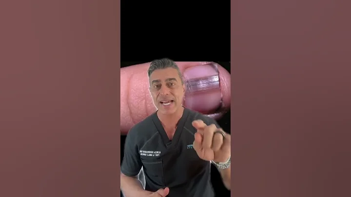 What your nails say about your health? - Dark Lined Nails