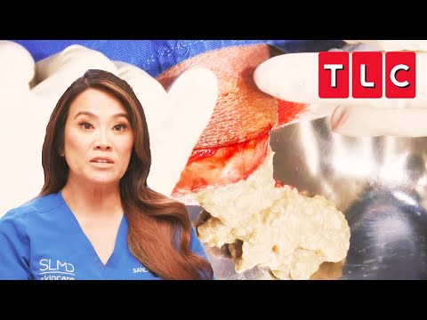 Most Extreme Pops From Season 7 PART 2 | Dr. Pimple Popper | TLC