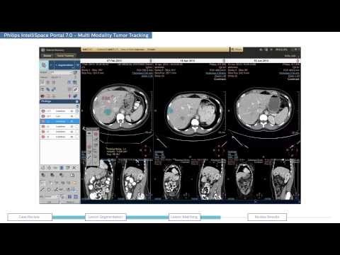 Philips IntelliSpace Portal 7.0 clinical application MMTT (Multi Modality Tumor Tracking)