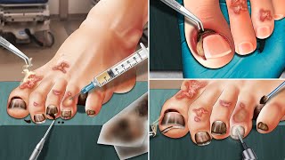 ASMR Remove ingrown toenails, cut toenails and beautify toenails