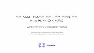 Nanox Vision | Clinical Case Study | Lumbar Vertebral Compression Fracture