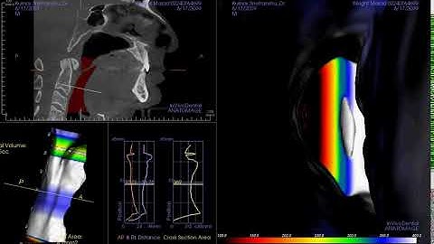 Airway Analysis Detail Video