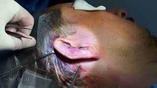 Otoplasty Before & After | 2-Month Ear Pinning Transformation & Recovery Journey