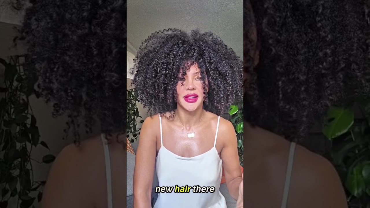 Hair growth. Trust the process. #hairloss #hairgrowth #hairtransplant #minoxidil