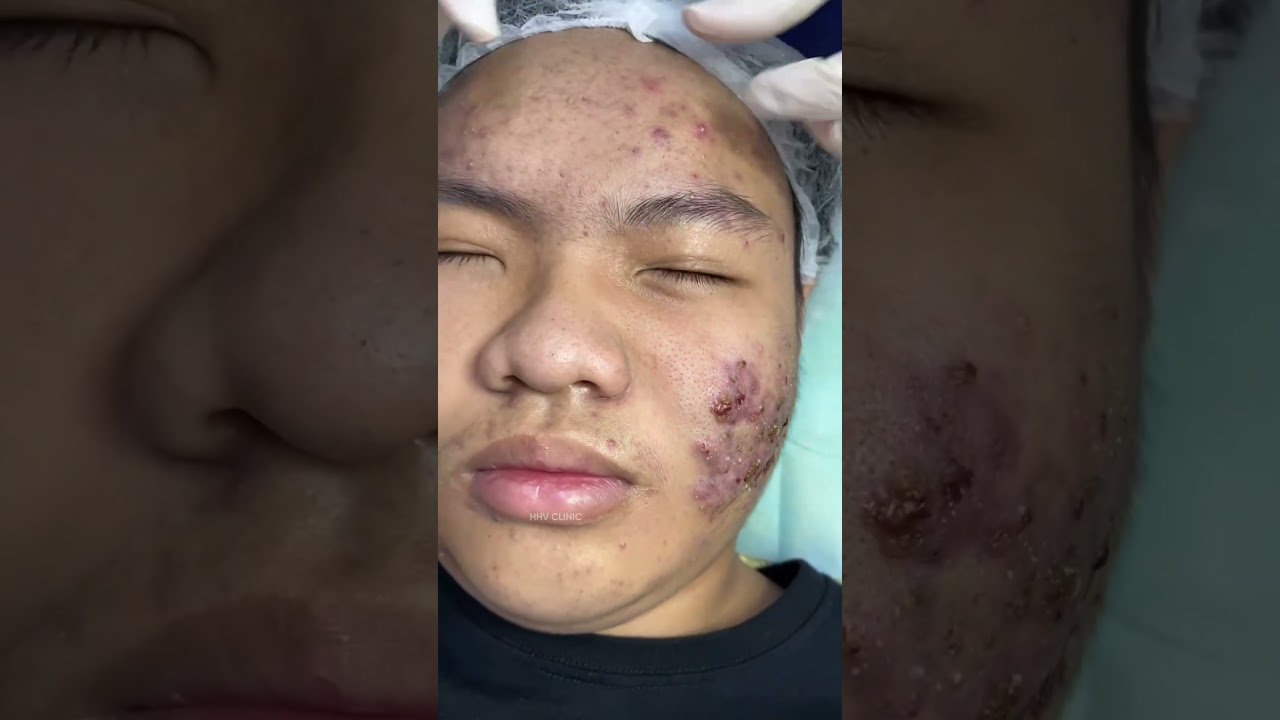Mụn sưng viêm kéo dài dấu hiệu ổ viêm ăn luồng.