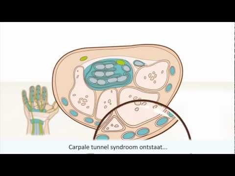 Video: Carpaal Tunnel Syndroom - Oorzaken, Symptomen, Diagnose En Behandeling