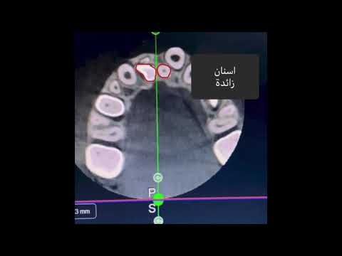 فيديو: هل الأسنان الزائدة نادرة؟