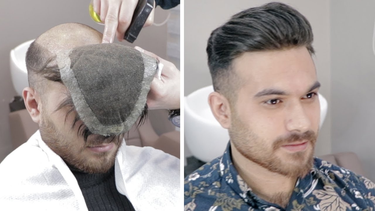 PROTEZ SAÇ UYGULAMASI - Hair Replacement