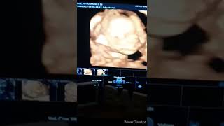 18 weeks 4 days Ultrasound in 2D/3D/4D/HD - Gender Reveal too! screenshot 2