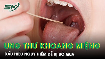 Ung thư khoang miệng: Dấu hiệu nguy hiểm dễ bị bỏ qua | SKĐS