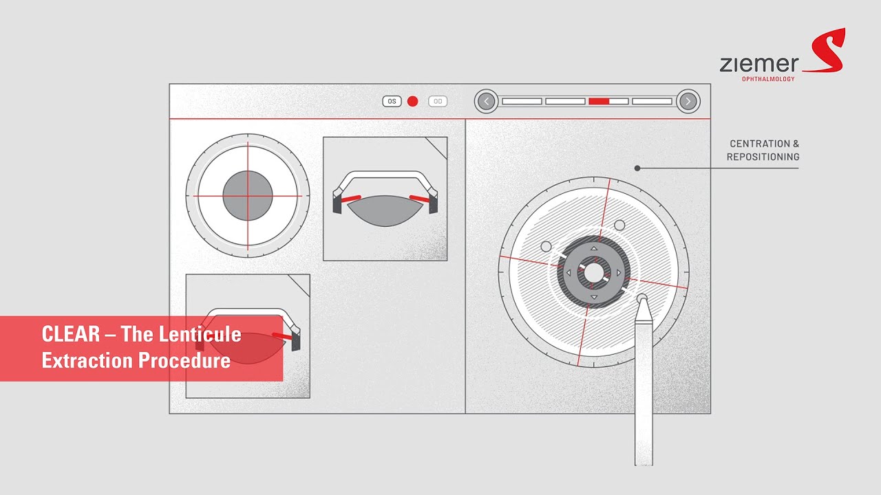CLEAR – The new Lenticule Procedure by Ziemer