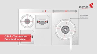 CLEAR β The new Lenticule Procedure by Ziemer