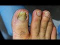 RIPPING OFF A FUNGAL TOENAIL ***REMOVING HUGE NAIL SPIKES***