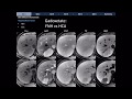 CT Differential Diagnosis of Focal Hepatic Lesions [Basic Radiology]